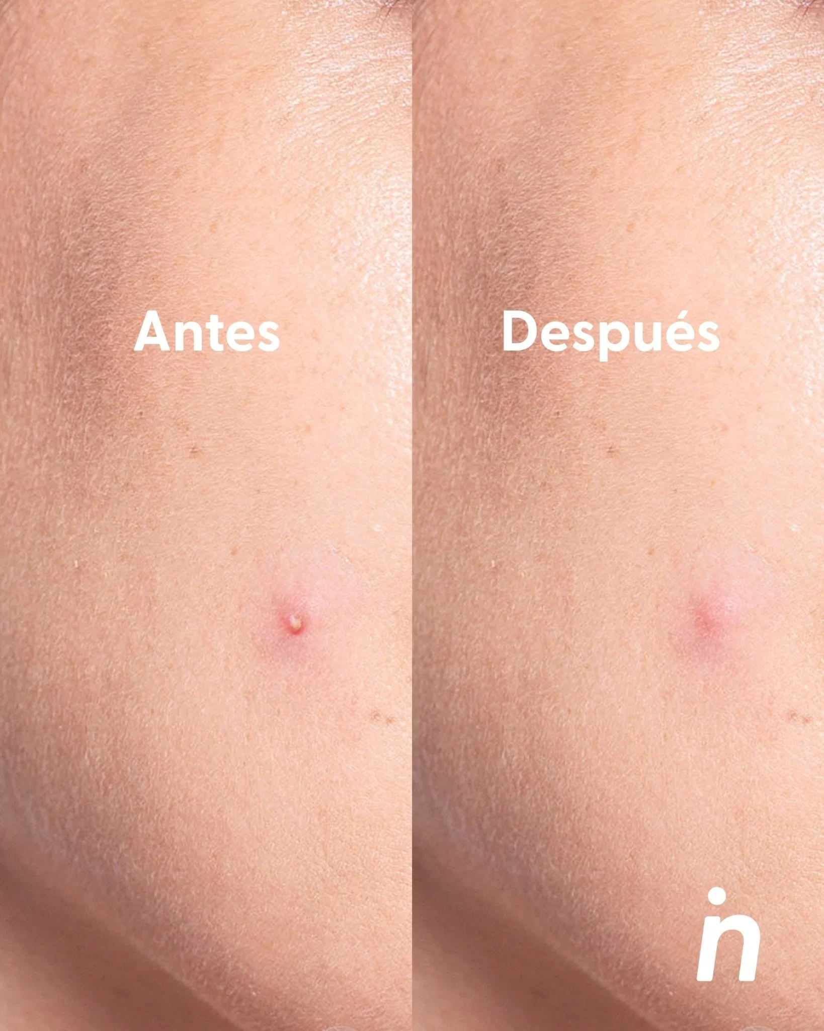 PARCHES PARA IMPERFECCIONES USO DE DIA - NIPSKIN - Image 2