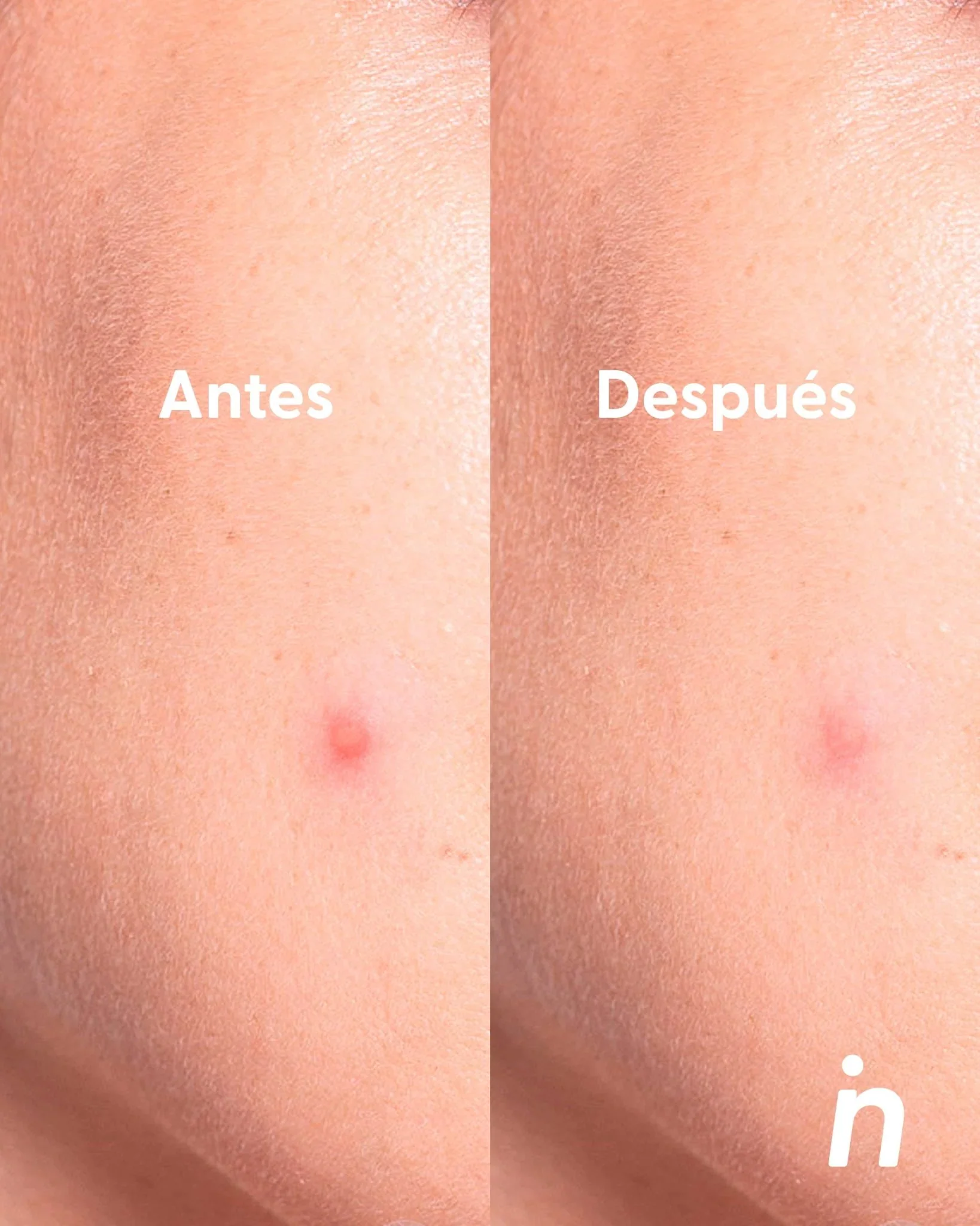 PARCHES PARA IMPERFECCIONES USO DE NOCHE - NIPSKIN - Image 3